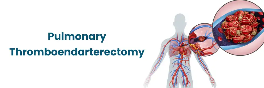Pulmonary Thromboendarterectomy Explained