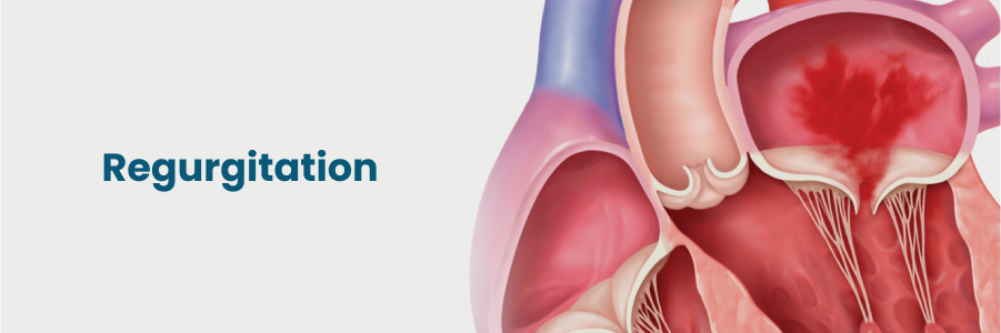 Regurgitation