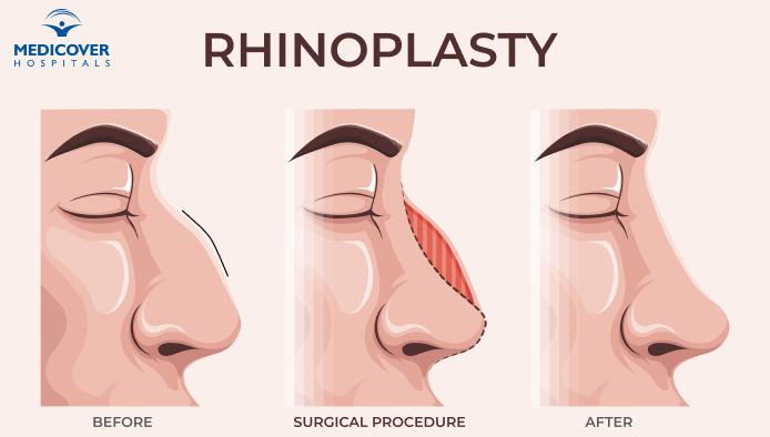 Rhinoplasty Cost in Hyderabad, Cost of Rhinoplasty in India