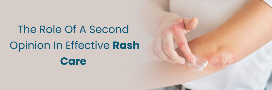 Role of a second opinion in effective rash treatment