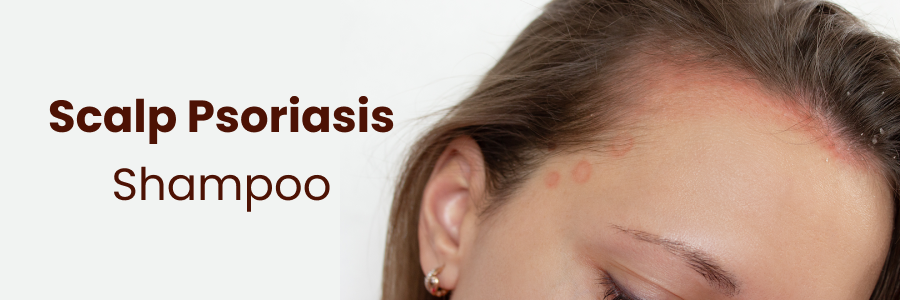 Scalp Psoriasis Shampoo