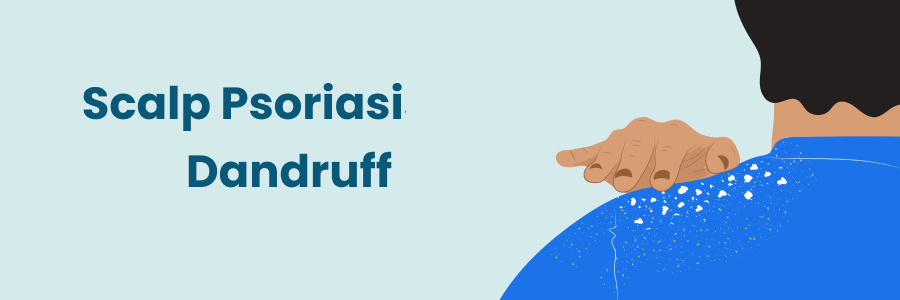 Scalp Psoriasis Vs Dandruff