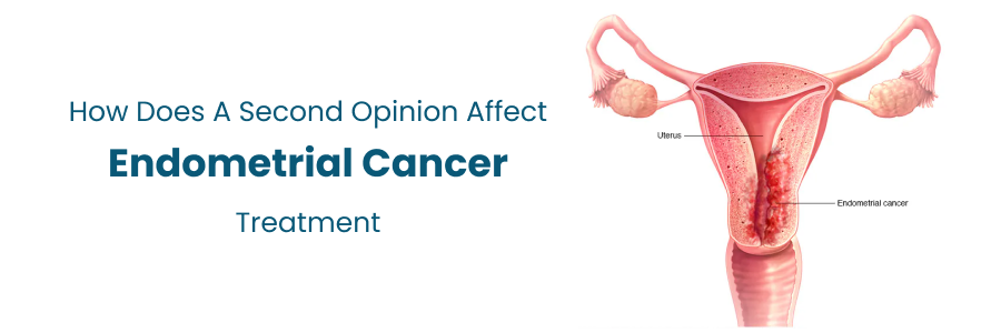 second opinion for endometrial cancer treatment