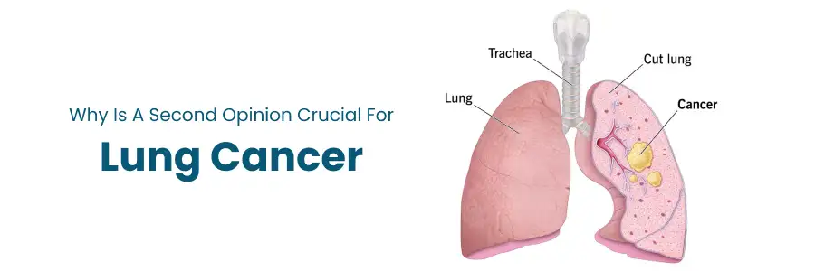 Second Opinion Matters for Lung Cancer Care