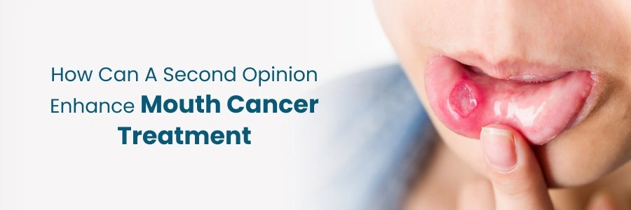 Second Opinion: Enhance Mouth Cancer Treatment