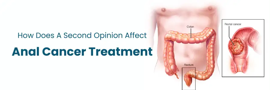 Second Opinion Anal Treatment
