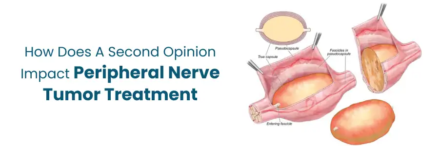 Second Opinion Impact on Peripheral Nerve Tumor Treatment