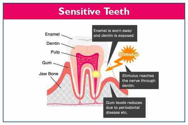 sensitive-teeth