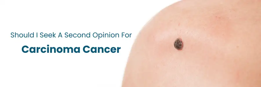 Should I Seek a Second Opinion for Carcinoma Cancer