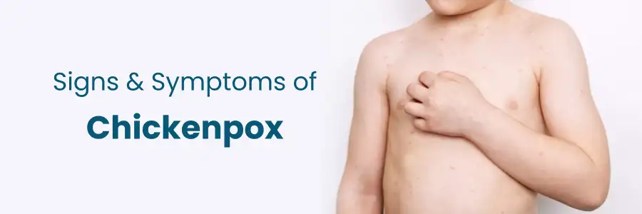 Signs And Symptoms Of Chickenpox