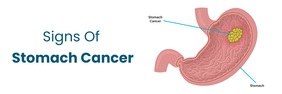 Signs Of Stomach Cancer
