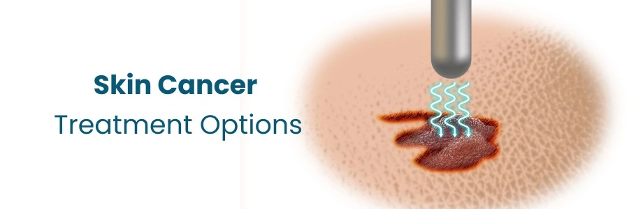 Skin Cancer Treatment Options