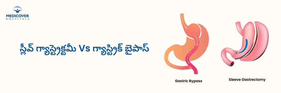 sleeve-gastrectomy-or-gastric-bypass-which-bariatric-surgery-is-right-for-you-telugu