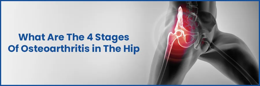 What Are The 4 Stages Of Osteoarthritis in The Hip