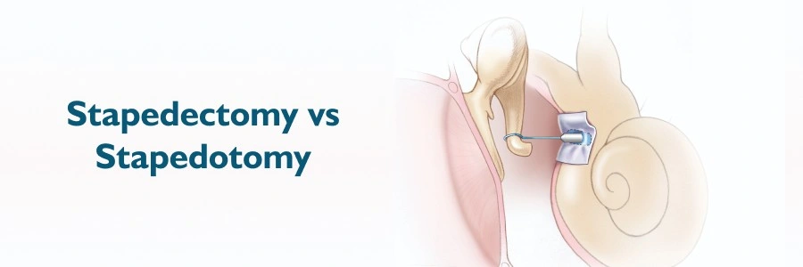 Stapedectomy and Stapedotomy