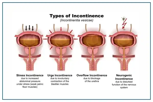 Stress Incontinence