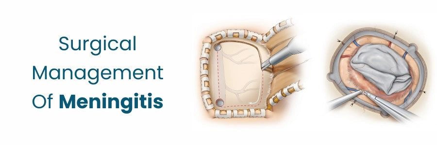 Surgical Management Of Meningitis
