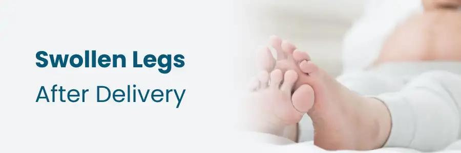 Swollen Legs After Delivery