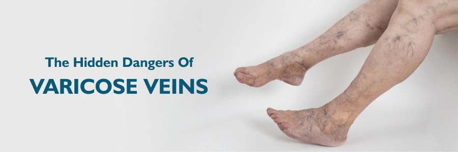 The Hidden Dangers of Varicose Veins