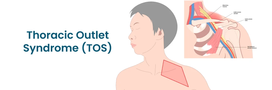 Thoracic Outlet Syndrome(TOS)