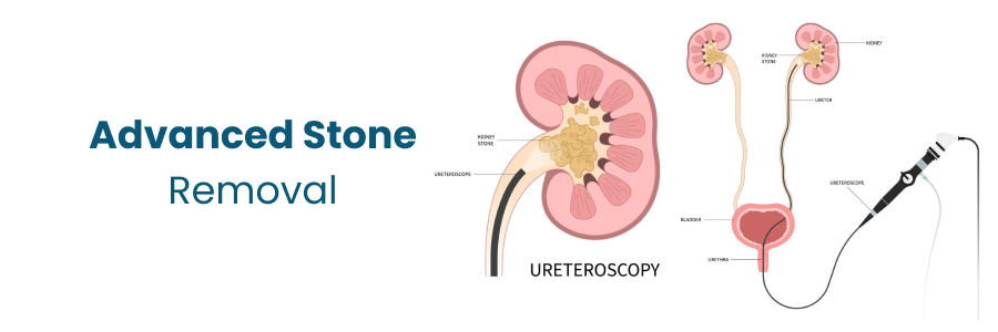 Treatments for Kidney Stone Removal
