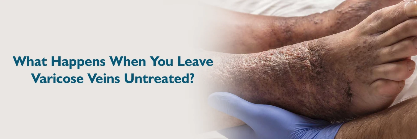 Untreated Varicose Veins