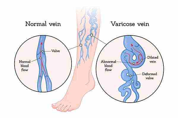 untreated-varicose-veins1