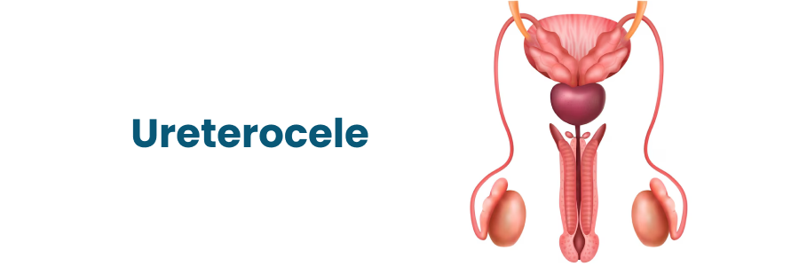Ureterocele