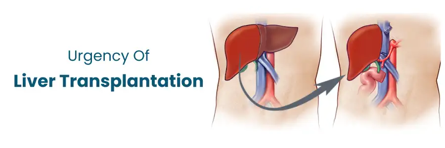 Urgency Of Liver Transplantation