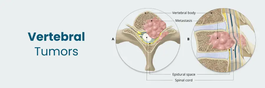 Vertebral Tumors: Symptoms and Treatment