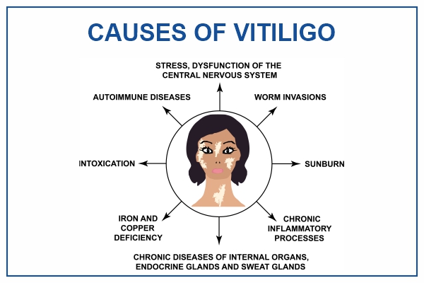 Vitiligo Causes