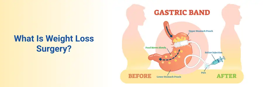 Weight Loss Surgery Procedure