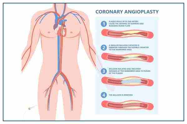 what-is-a-coronary-angiogram1