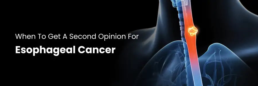 When to Get a Second Opinion for Esophageal Cancer