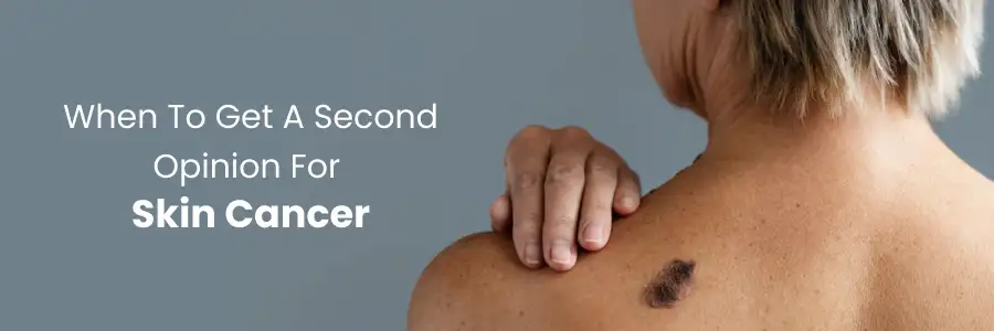 When to Get a Second Opinion for Skin Cancer