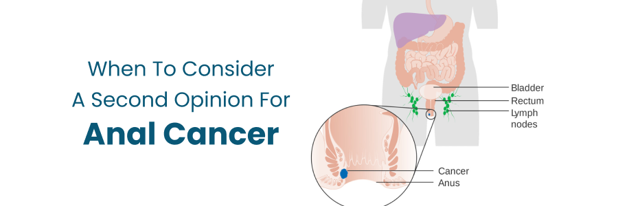 Anal Cancer Second Opinion Timing