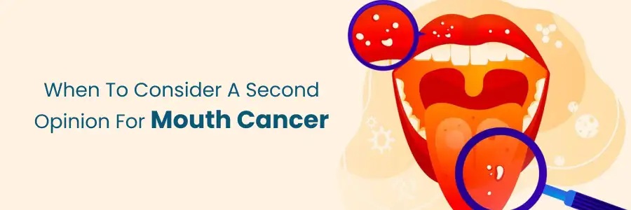 Considering a second opinion for mouth cancer