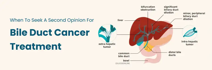 When to Seek a Second Opinion for Bile Duct Cancer