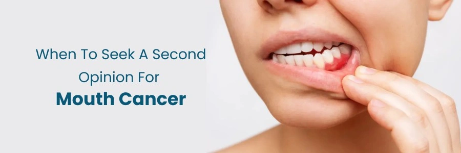 Know When to Seek a Second Opinion for Mouth Cancer