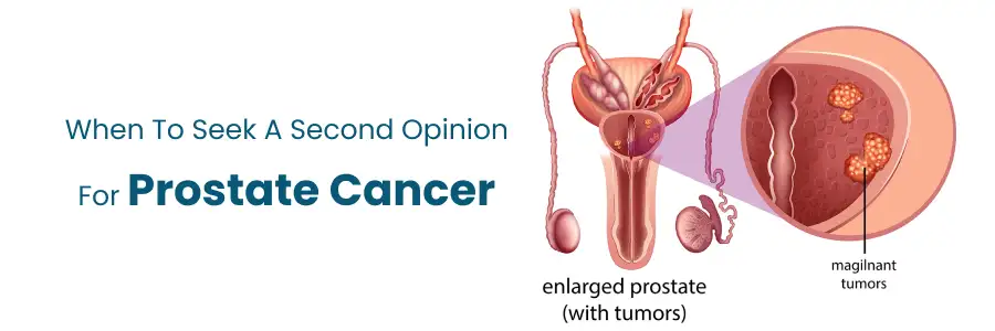 Seek a Second Opinion for Prostate Cancer