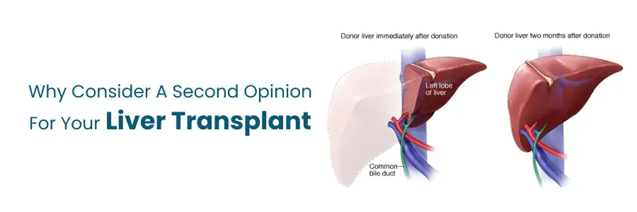 Reasons to obtain a second opinion for liver transplant.