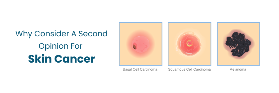 Why Consider a Second Opinion for Skin Cancer