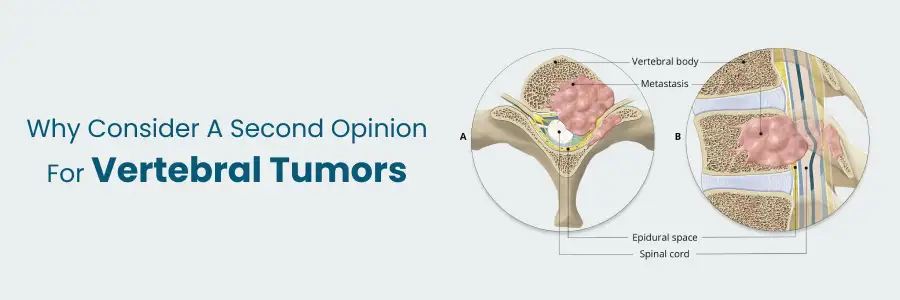 Consider a Second Opinion for Vertebral Tumours to confirm diagnosis