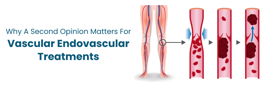 Importance of second opinion in endovascular