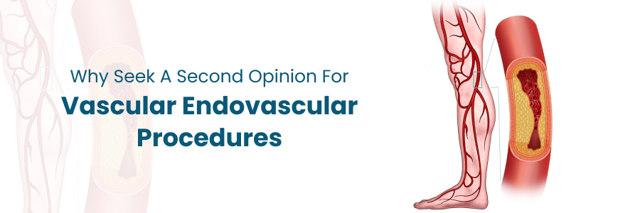Seeking second opinion for endovascular care