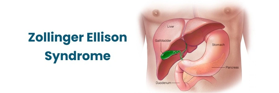 Zollinger Ellison Syndrome