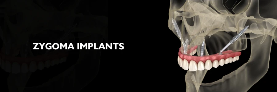 Zygoma Implants
