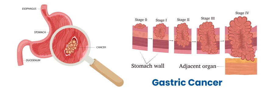 gastric-cancer