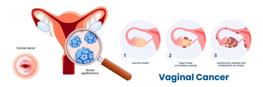 vaginal-cancer
