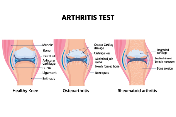 arthritis test